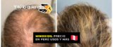 Minoxidil precio en Perú usos y más